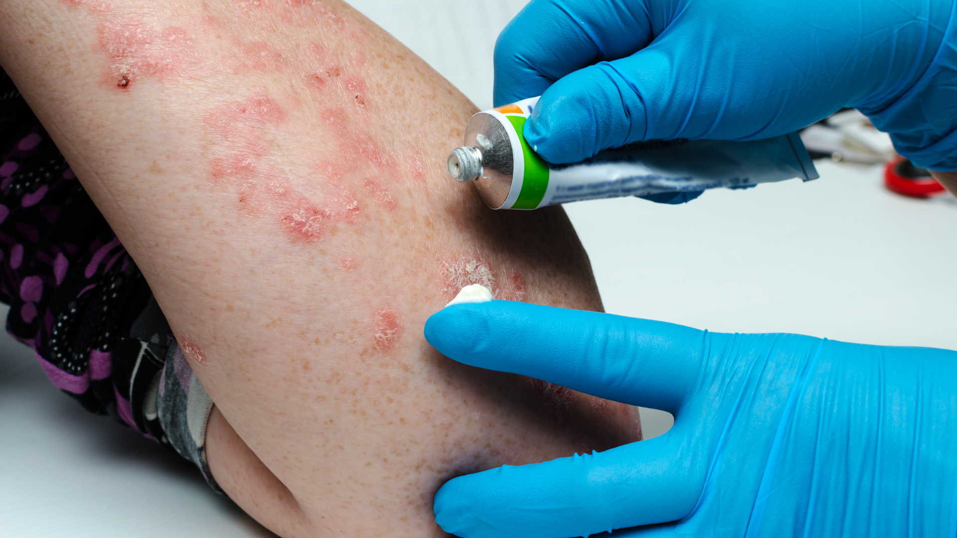 Dermatoses Ocupacionais | WTA Medicina do Trabalho